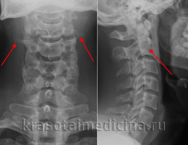 Рентгенография ШОП. Множественные шейные ребра.